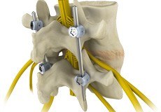 Spinal Fusion