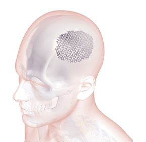 Cranioplasty