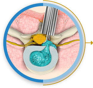 Minimally invasive Spine surgery