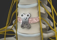 Anterior Cervical Discectomy And Fusion
