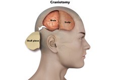 Craniotomy for Trauma, Tumor, Infection, Hematoma evacuation